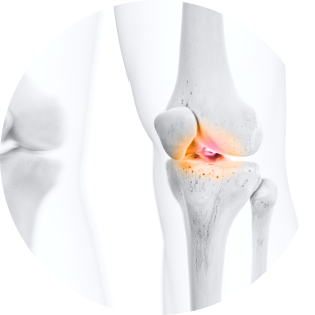 white 3D render of knee bone with orange shading at the joint indicating inflammation.
